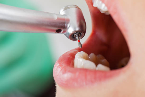 Best Dentist for Tooth Abscess  in Clarkdale, AZ